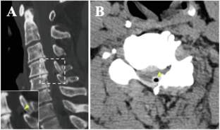 A patient with cervical ligamentum flavum haematoma: case report.