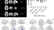 Brain structural changes in diabetic retinopathy patients: a combined voxel-based morphometry and surface-based morphometry study.