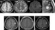 Novel case of ependymoma-like tumor with mesenchymal differentiation harboring ZFTA::RELA fusion in an adult.