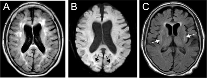 Wilson disease (novel ATP7B variants) with concomitant FLNC-related cardiomyopathy.