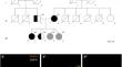 Pseudodominance in RFC1-Spectrum Disorder.