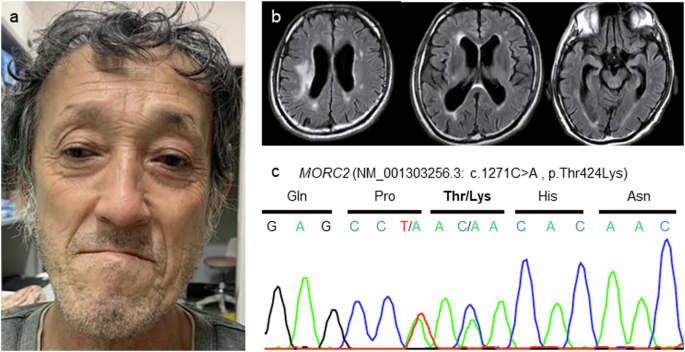 Intermediate phenotype between CMT2Z and DIGFAN associated with a novel MORC2 variant: a case report.