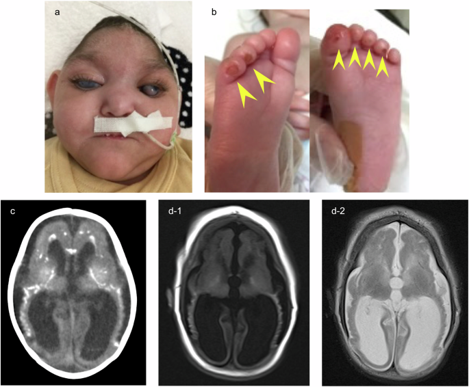 A case of severe Aicardi-Goutières syndrome with a homozygous RNASEH2B intronic variant.