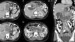 Gastrogastric and Gastroduodenal Intussusception After Gastric Plication.