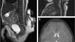 Regression of Chiari malformation type 2 following early postnatal meningomyelocele repair-a retrospective observation from an institutional series of patients.