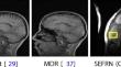 A lightweight self-ensemble feedback recurrent network for fast MRI reconstruction