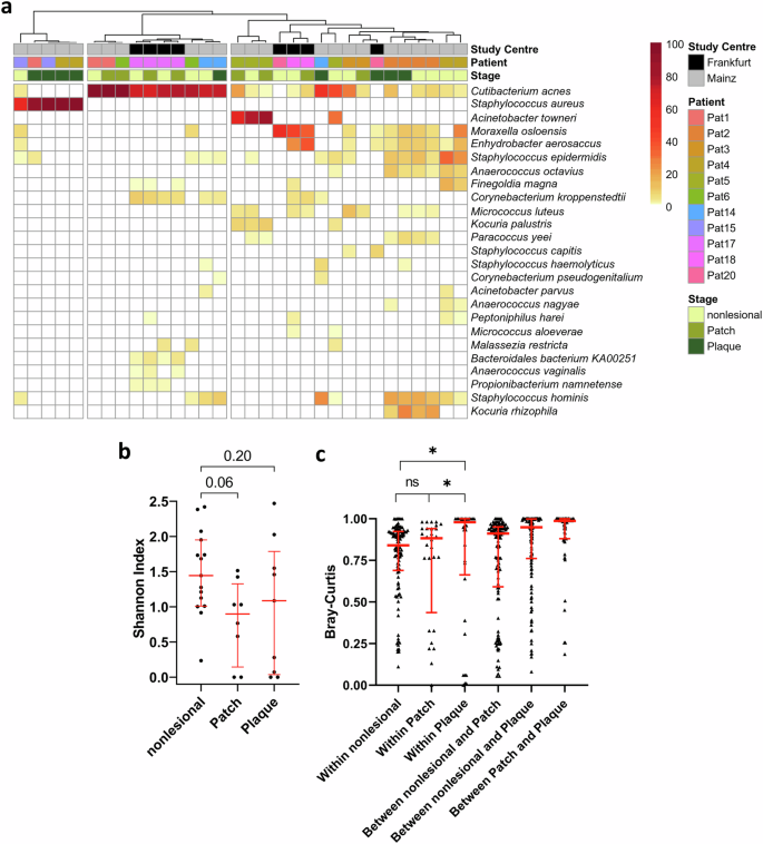 The skin microbiome stratifies patients with cutaneous T cell lymphoma and determines event-free survival.