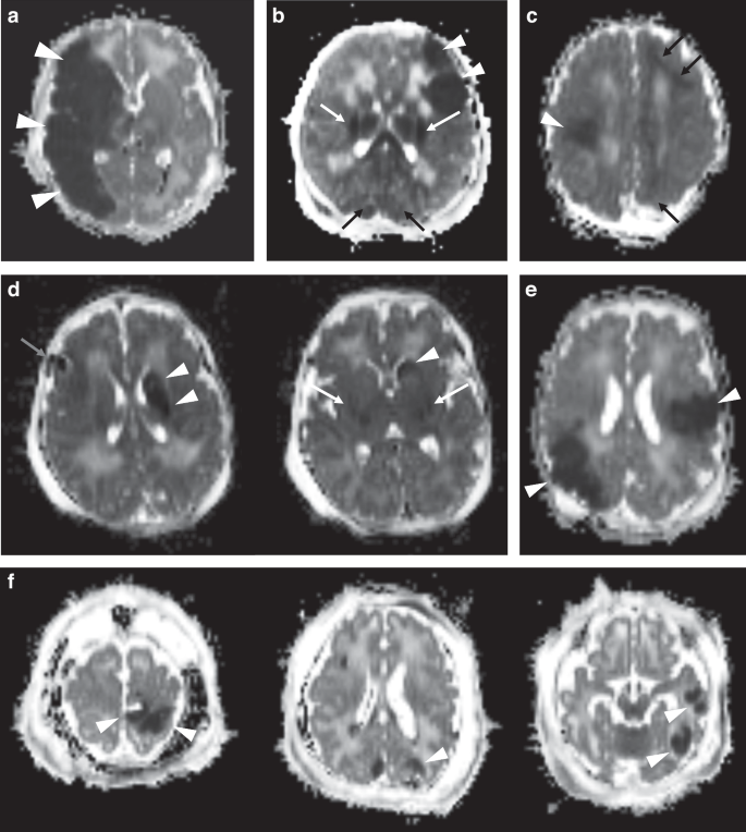 Perinatal arterial ischemic stroke diagnosed in infants receiving therapeutic hypothermia for hypoxic-ischemic encephalopathy.