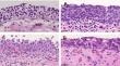 Comparative analysis of non-coding and coding DNA mutations in flat urothelial lesions: biological implications and insights.