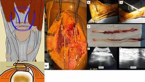 Reconstructing Quadriceps Tendon Disruptions in Post Total Knee Arthroplasty Patients with an Autogenous Peroneal Tendon Graft: A Viable Alternative