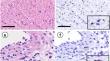 Quantification of Gremlin 1 throughout the tumor stroma using whole slide imaging and its clinicopathological significance in gastric cancer.