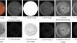 Image decomposition based segmentation of retinal vessels