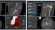 The Accuracy of CT-Based Three-Dimensional Templating in Predicting Implant Sizes in Patients Undergoing Robot-Assisted Total Knee Arthroplasty