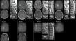 Unusual demyelinating disease in a patient with HIV infection.