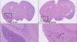 PD-L1 and VEGF dual blockade enhances anti-tumor effect on brain metastasis in hematogenous metastasis model.