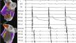 Achieving a steady pulse with pulse field ablation.