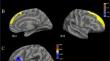 APOE4-related differences in cortical thickness are modulated by sex in middle age.