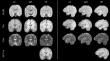 Evaluation of epilepsy lesion visualisation enhancement in low-field MRI using image quality transfer: a preliminary investigation of clinical potential for applications in developing countries.