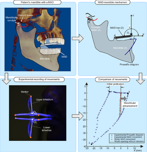 Kinematics of mandibular advancement devices (MADs): Why do some MADs move the lower jaw backward during mouth opening?