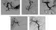 Percutaneous recanalization of non-cirrhotic extrahepatic portal vein obstruction in children: technical considerations in a preliminary cohort.