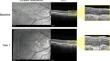 Predict and Protect: Evaluating the Double-Layer Sign in Age-Related Macular Degeneration.