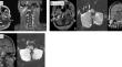 Meningitis and intracranial abscess due to Mycoplasma pneumoniae in a B cell-depleted patient with multiple sclerosis