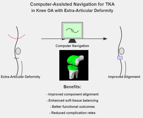 Progress in Computer-Assisted Navigation for Total Knee Arthroplasty in Treating Knee Osteoarthritis with Extra-Articular Deformity.