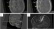 Robot-assisted insular stereoelectroencephalography in pediatric drug-resistant epilepsy: accuracy and diagnostic value.