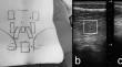 The effects of spinal flexion exposure on lumbar muscle shear modulus and posture.