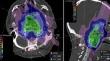 Robust IMPT and follow-up toxicity in skull base chordoma and chondrosarcoma-a single-institution clinical experience.