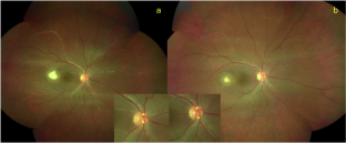 Kyrieleis plaques at optic nerve head in ocular toxoplasmosis