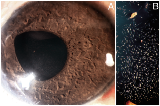 Neurofibromatosis with 'stars in the sky'.