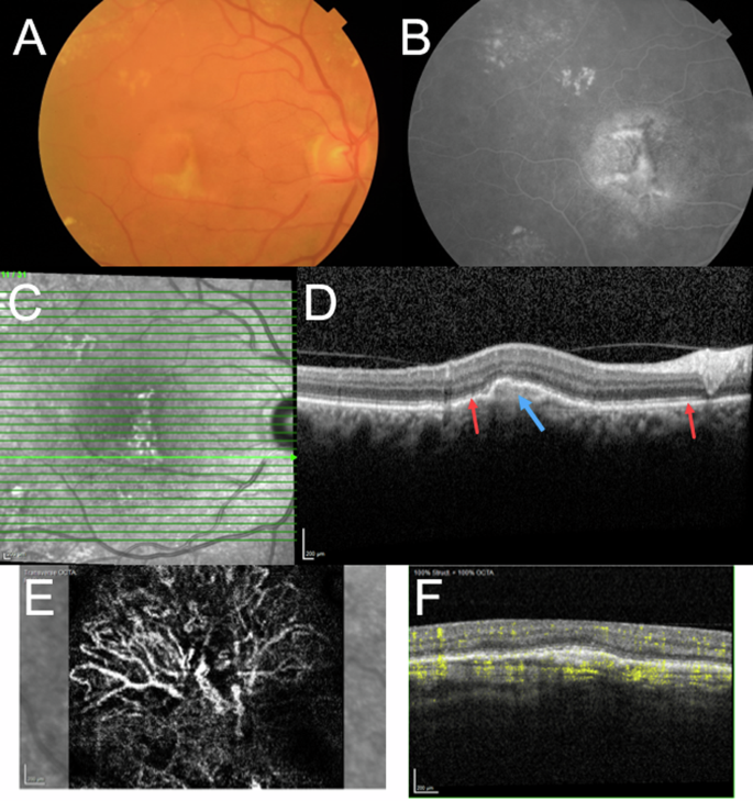 Fibrosis in age-related neovascular macular degeneration in the anti-VEGF era.