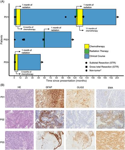 Lack of classical astroblastoma features in pediatric MN1::BEND2-fused brain tumors.