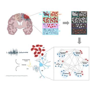 The complex molecular epileptogenesis landscape of glioblastoma.