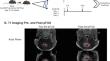 Pulsed focused ultrasound alters the proteomic profile of the tumor microenvironment in a syngeneic mouse model of glioblastoma.