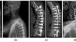 The more the better? Integration of vertebral pelvic angles (VPA) PJK thresholds to existing alignment schemas for prevention of mechanical complications after adult spinal deformity surgery.