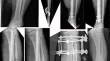 Treatment of Diaphyseal Tibial Non-unions After Open Fracture: A Retrospective Observational Study on Characteristics and Outcomes