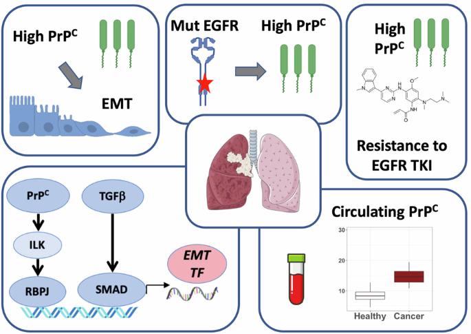 PrPC controls epithelial-to-mesenchymal transition in EGFR-mutated NSCLC: implications for TKI resistance and patient follow-up