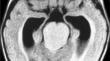 Upper brainstem pediatric low-grade gliomas: review and neuroendoscopic approach.