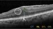 Visual prognostic factors following surgery for stage 3 idiopathic epiretinal membrane by Govetto classification.