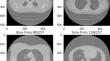 Deep Learning Models for Lung Nodule Segmentation: A Comparative Study