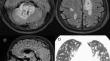 Advanced Lymphomatoid Granulomatosis Involving the Central Nervous System and Lung Parenchyma Presenting with Speech and Gait Disturbances