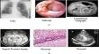 Advancements in brain tumor analysis: a comprehensive review of machine learning, hybrid deep learning, and transfer learning approaches for MRI-based classification and segmentation