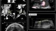 Resolution of oval thrombus in a case of external jugular venous aneurysm.