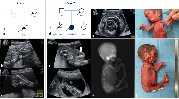 Missense BICD2 variants in fetuses with congenital arthrogryposis and pterygia.