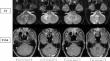 Progressive multifocal leukoencephalopathy in sarcoidosis successfully treated with pembrolizumab.