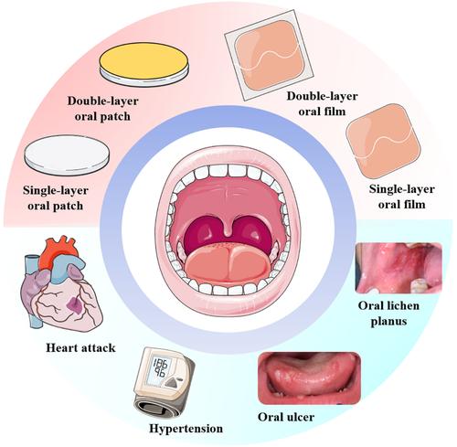 Oral Patch/Film for Drug Delivery-Current Status and Future Prospects.