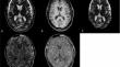 Atezolizumab- and bevacizumab -induced encephalitis in a patient with advanced hepatocellular carcinoma: a case report and literature review.