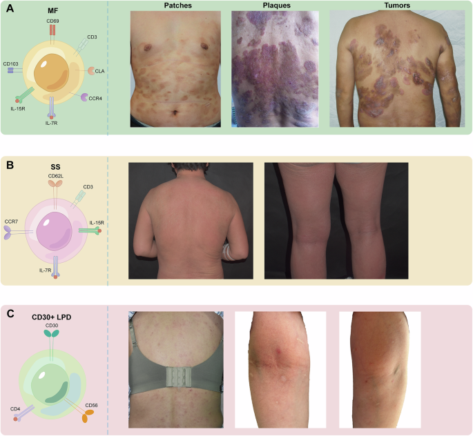 Non-coding RNAs in the spotlight of the pathogenesis, diagnosis, and therapy of cutaneous T cell lymphoma